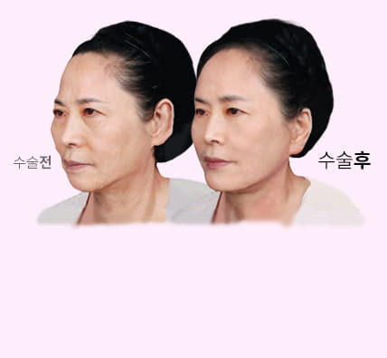 미세자가 지방이식