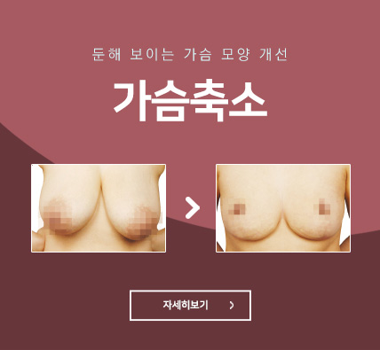 가슴축소 - 둔해 보이는 가슴 모양 개선