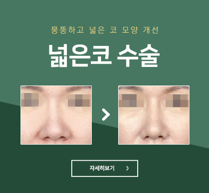 넓은코성형